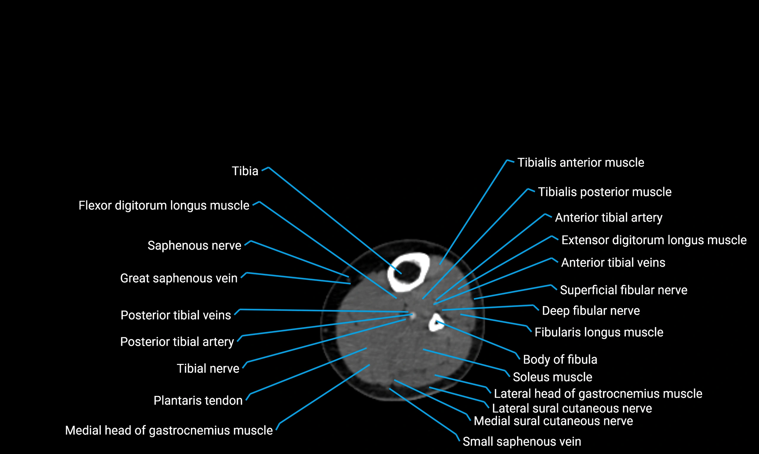 CT lower limb axial cross sectional anatomy labelled image 109 (2).webp
